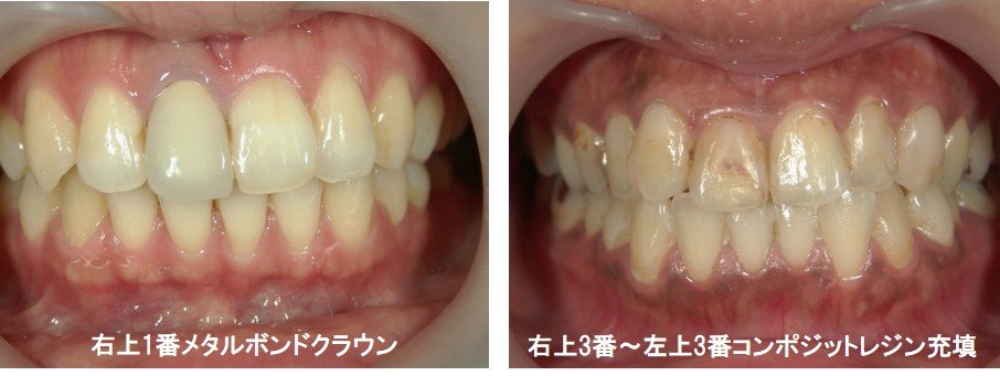 補綴物・修復物の例