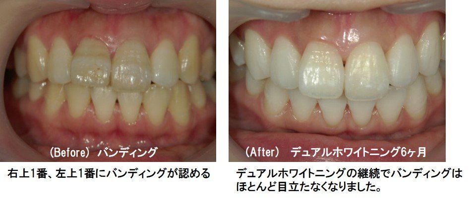 バンディングのホワイトニング症例