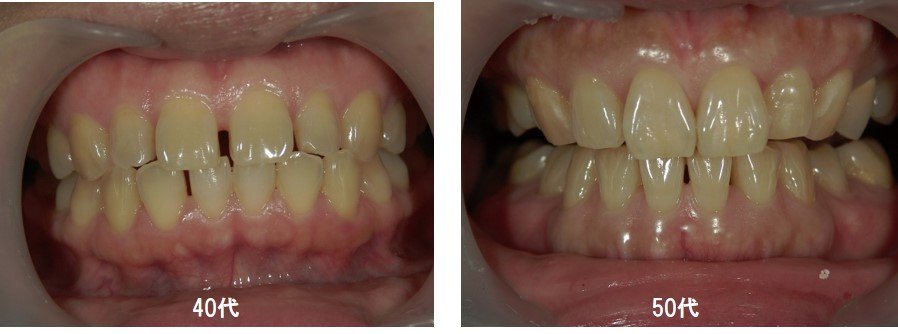 加齢による黄ばみの事例画像