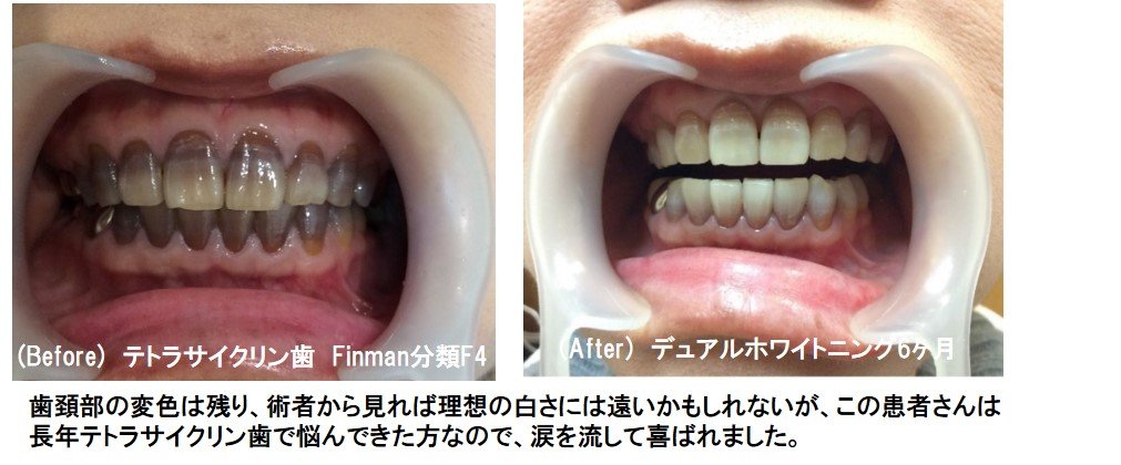 テトラサイクリン歯のホワイトニング症例