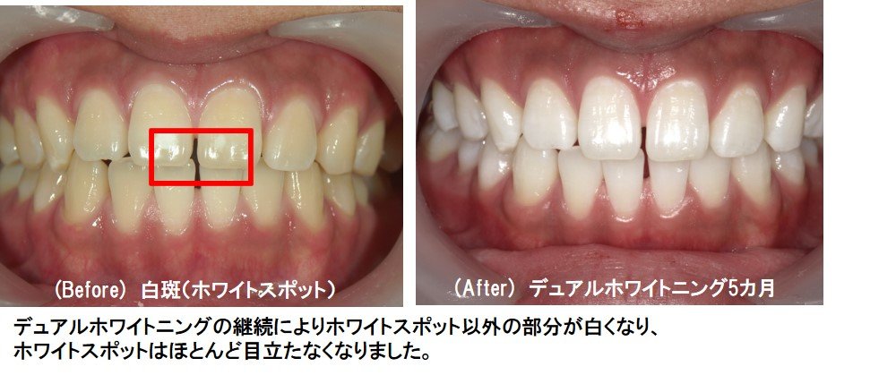 ホワイトスポットのホワイトニング症例