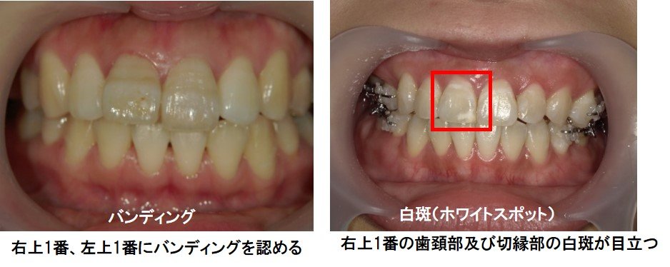 バンディング、ホワイトスポットの事例画像